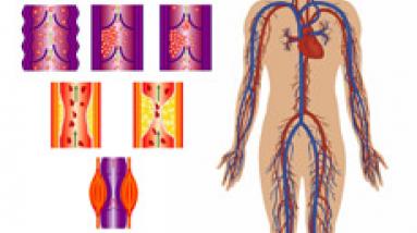 Болезни периферических сосудов