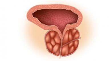 Аденома простаты