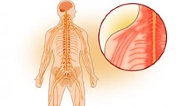 Болезни нервных корешков и сплетений