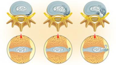 Поражение межпозвоночных дисков