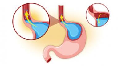Гастроэзофагеальная рефлюксная болезнь