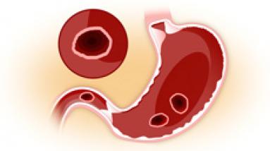 Язва желудка и двенадцатиперстной кишки