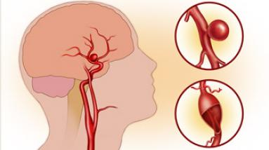 Аневризма сосудов головного мозга