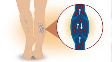 Варикозное расширение вен нижних конечностей