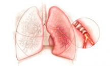 Аллергическая бронхиальная астма