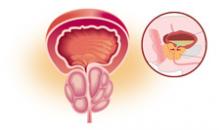 Простатит