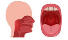 Хронический фарингит