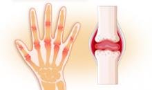 Артропатия