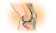 Остеоартроз