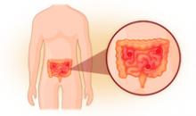 Дискинезия кишечника