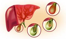 Заболевания желчевыводящих путей