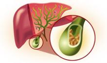 Желчнокаменная болезнь