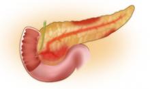 Панкреатит