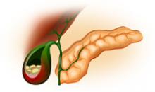 Холецистит