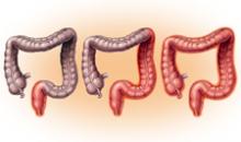 Хронический колит