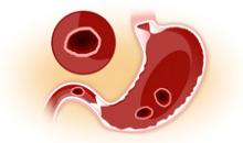 Язва желудка и двенадцатиперстной кишки